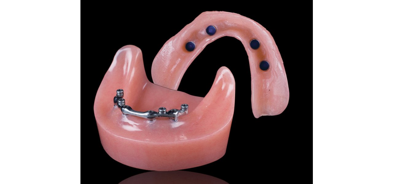 Implantatgetragenen herausnehmbaren Zahnersatz