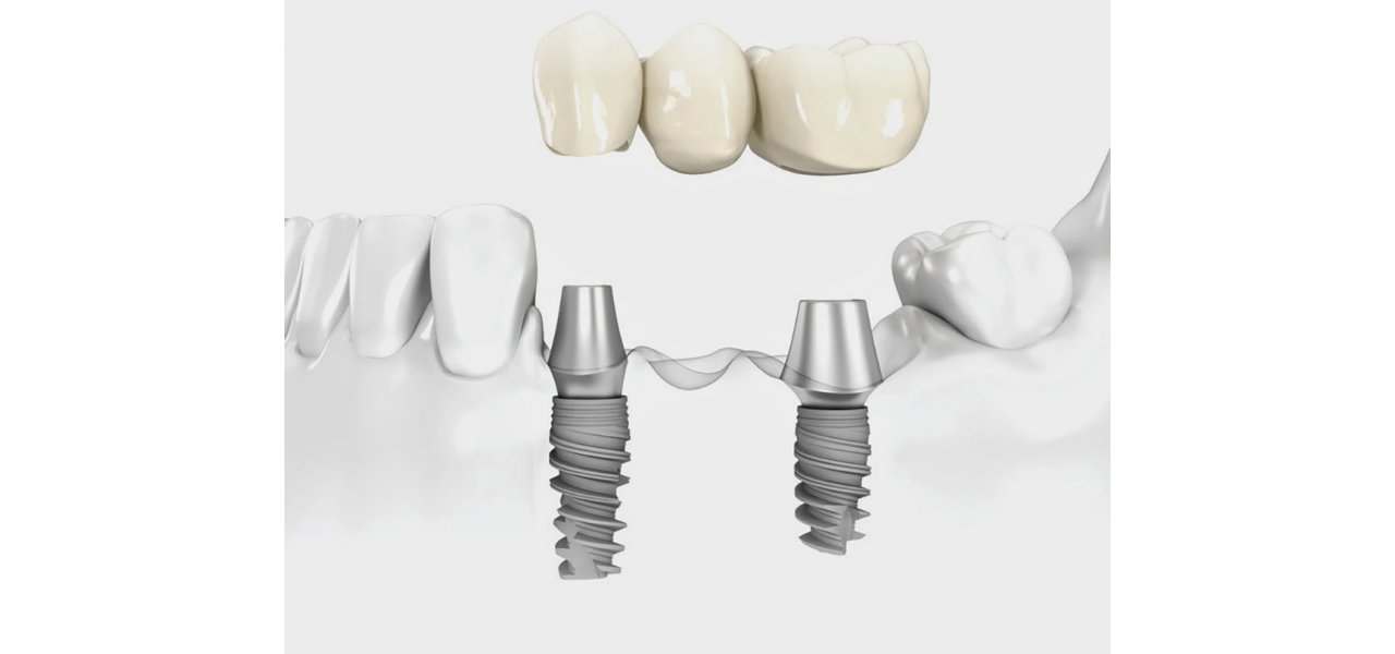 Implantatgetragene festsitzenden Zahnersatz