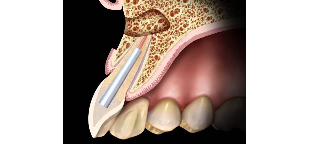 Apical Resection