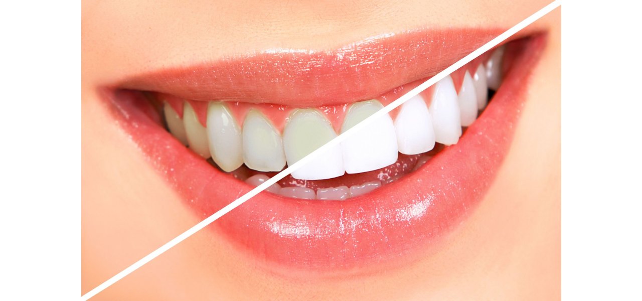 Teeth Whitening ( Bleaching )