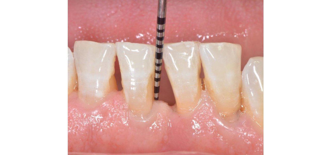 Subgingival Curettage